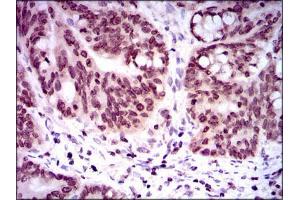 Immunohistochemical analysis of paraffin-embedded rectum cancer tissues using NR6A1 mouse mAb with DAB staining.