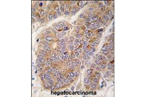 Formalin-fixed and paraffin-embedded human hepatocarcinoma tissue reacted with APOA2 antibody , which was peroxidase-conjugated to the secondary antibody, followed by DAB staining. (APOA2 anticorps  (AA 28-56))