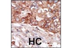 Formalin-fixed and paraffin-embedded human cancer tissue reacted with the primary antibody, which was peroxidase-conjugated to the secondary antibody, followed by AEC staining.