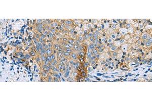 Immunohistochemistry of paraffin-embedded Human cervical cancer tissue using CLTB Polyclonal Antibody at dilution of 1:70(x200)