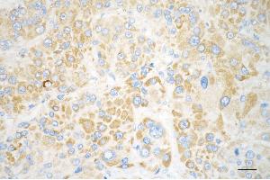 Immunohistochemistry was performed on paraffin-embedded human hepatocarcinoma using citrate synthetase antibody (ABIN7798088), 1:200).