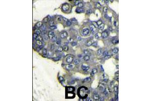 Formalin-fixed and paraffin-embedded human breast carcinoma reacted with PIK3CD polyclonal antibody  , which was peroxidase-conjugated to the secondary antibody, followed by DAB staining. (PIK3CD anticorps  (N-Term))