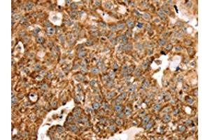 The image on the left is immunohistochemistry of paraffin-embedded Human breast cancer tissue using ABIN7192683(STK32B Antibody) at dilution 1/25, on the right is treated with synthetic peptide. (STK32B anticorps)