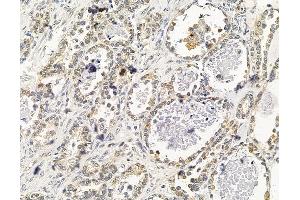 ABIN7095963 and ABIN7100025 at 1/100 staining human ovarian cancer by IHC-P. (NSMAF anticorps)