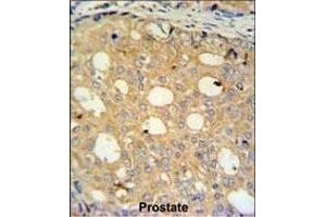 CK2 Antibody (Center) (ABIN651399 and ABIN2840216) IHC analysis in formalin fixed and paraffin embedded human prostate carcinoma followed by peroxidase conjugation of the secondary antibody and DAB staining.