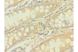 Immunohistochemistry of paraffin-embedded human colon cancer using ABIN7166896 at dilution of 1:100