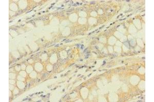 Immunohistochemistry of paraffin-embedded human colon cancer using ABIN7166896 at dilution of 1:100 (PDHA1 anticorps  (AA 223-390))