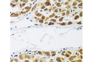 Immunohistochemistry of paraffin-embedded Human liver cancer using NAA60 Polyclonal Antibody at dilution of 1:200 (40x lens).