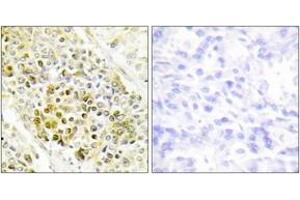 Immunohistochemistry analysis of paraffin-embedded human lung carcinoma tissue, using DLX5 Antibody. (DLX5 anticorps  (AA 91-140))