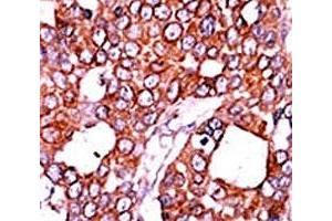 IHC analysis of FFPE human breast carcinoma tissue stained with the CDC25A antibody. (CDC25A anticorps  (pThr507))