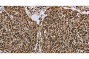Immunohistochemistry of paraffin-embedded Human cervical cancer using PPAT Polyclonal Antibody at dilution of 1:50 (PPAT anticorps)