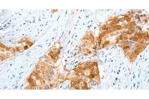 Immunohistochemistry of paraffin-embedded Human cervical cancer using ANXA8 Polyclonal Antibody at dilution of 1:35 (Annexin VIII anticorps)