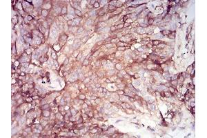 Immunohistochemical analysis of paraffin-embedded bladder cancer tissues using SERPINA1 mouse mAb with DAB staining.