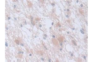 Detection of CAPNS1 in Human Glioma Tissue using Polyclonal Antibody to Calpain, Small Subunit 1 (CAPNS1)