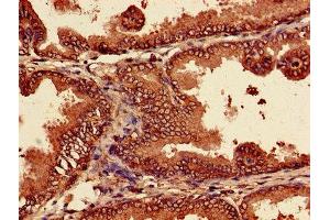 Immunohistochemistry of paraffin-embedded human prostate cancer using ABIN7164964 at dilution of 1:100 (PSMA7 anticorps  (AA 5-232))