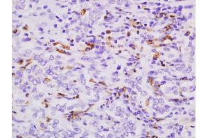 Formalin-fixed and paraffin embedded human cholangiocarcinoma tissue labeled with Anti-S100-A9 Polyclonal Antibody, Unconjugated  followed by conjugation to the secondary antibody and DAB staining. (S100A9 anticorps  (AA 51-114))