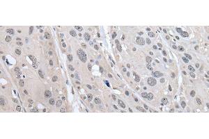 Immunohistochemistry of paraffin-embedded Human esophagus cancer tissue using PRAME Polyclonal Antibody at dilution of 1:65(x200) (PRAME anticorps)