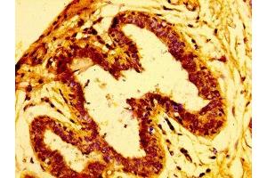 IHC image of ABIN7145776 diluted at 1:100 and staining in paraffin-embedded human breast cancer performed on a Leica BondTM system.