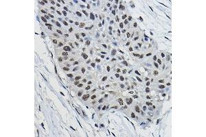 Immunohistochemistry of paraffin-embedded human lung cancer using BRAP Rabbit pAb (ABIN7265922) at dilution of 1:100 (40x lens). (BRAP anticorps  (AA 1-200))