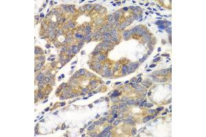 Immunohistochemistry of paraffin-embedded human gastric cancer using PFKM antibody at dilution of 1:100 (x40 lens). (PFKM anticorps)