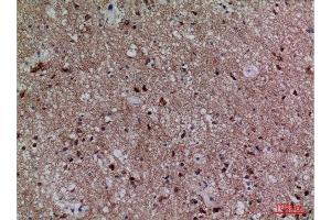 Immunohistochemistry (IHC) analysis of paraffin-embedded Human Lung Cancer, antibody was diluted at 1:100.
