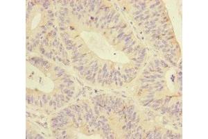 Immunohistochemistry of paraffin-embedded human colon cancer using ABIN7145574 at dilution of 1:100 (MTHFD2 anticorps  (AA 40-250))