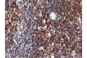 Immunohistochemical staining of paraffin-embedded Human lymphoma tissue using anti-ARHGAP25 mouse monoclonal antibody.