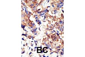 Formalin-fixed and paraffin-embedded human cancer tissue reacted with UBQLN2 polyclonal antibody  , which was peroxidase-conjugated to the secondary antibody, followed by DAB staining. (Ubiquilin 2 anticorps  (N-Term))