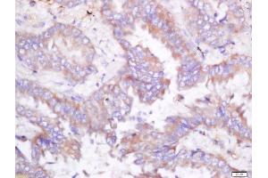 Formalin-fixed and paraffin embedded human lung carcinoma labeled with Rabbit Anti-ODC Polyclonal Antibody, Unconjugated (ABIN674559) at 1:200 followed by conjugation to the secondary antibody and DAB staining (ODC1 anticorps  (AA 321-461))