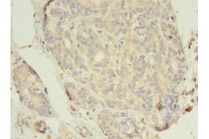 Immunohistochemistry of paraffin-embedded human breast cancer using ABIN7152043 at dilution of 1:100