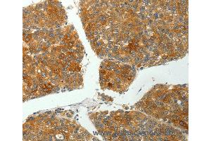 Immunohistochemistry of Human liver cancer using PTPN6 Polyclonal Antibody at dilution of 1:35 (SHP1 anticorps)