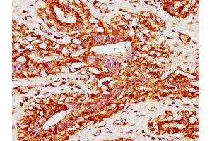 IHC image of ABIN7165686 diluted at 1:400 and staining in paraffin-embedded human breast cancer performed on a Leica BondTM system.