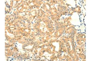 The image on the left is immunohistochemistry of paraffin-embedded Human thyroid cancer tissue using ABIN7131115(SNAP25 Antibody) at dilution 1/25, on the right is treated with fusion protein.