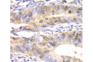 Immunohistochemistry of paraffin-embedded Human colon carcinoma using UBE2C Polyclonal Antibody at dilution of 1:100 (40x lens). (UBE2C anticorps)