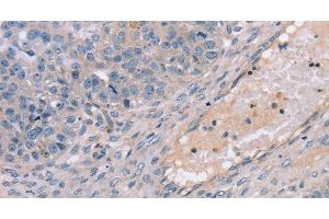 Immunohistochemistry of paraffin-embedded Human breast cancer using TERT Polyclonal Antibody at dilution of 1:35 (TERT anticorps)