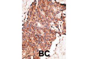 Formalin-fixed and paraffin-embedded human cancer tissue reacted with BMP1 polyclonal antibody  , which was peroxidase-conjugated to the secondary antibody, followed by AEC staining. (BMP1 anticorps  (C-Term))
