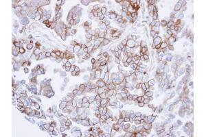 IHC-P Image Immunohistochemical analysis of paraffin-embedded OVCAR3 xenograft , using SNTB2, antibody at 1:500 dilution. (SNTB2 anticorps)