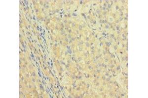 Immunohistochemistry of paraffin-embedded human liver cancer using ABIN7156085 at dilution of 1:100