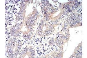 Immunohistochemical analysis of paraffin-embedded esophagus tissues using PLCG1 mouse mAb with DAB staining.
