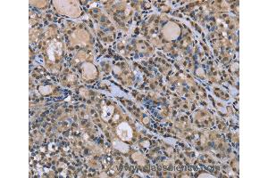 Immunohistochemistry of Human esophagus cancer using DYNLL1 Polyclonal Antibody at dilution of 1:30 (DYNLL1 anticorps)