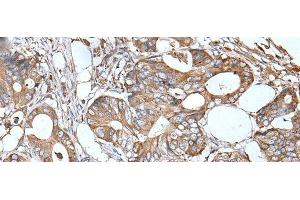 Immunohistochemistry of paraffin-embedded Human colorectal cancer tissue using APOD Polyclonal Antibody at dilution of 1:55(x200) (Apolipoprotein D anticorps)