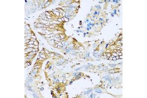 Immunohistochemistry of paraffin-embedded human colon carcinoma using APOC1 antibody at dilution of 1:100 (40x lens). (APOC1 anticorps)