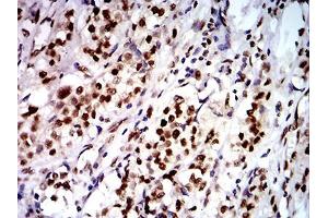Immunohistochemical analysis of paraffin-embedded bladder cancer tissues using DDX1 mouse mAb with DAB staining.