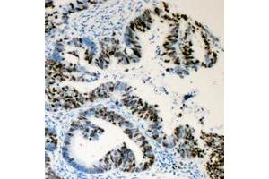 Immunohistochemical analysis of Lamin A/C (pS392) staining in human colon cancer formalin fixed paraffin embedded tissue section. (Lamin A/C anticorps  (pSer392))