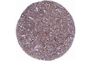 B CLL with strong ZAP70 staining of tumor cells and even stronger staining in interspersed normal T lymphocytes