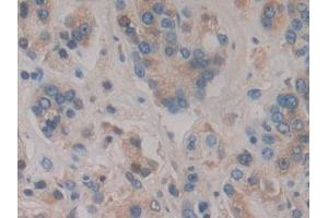 Detection of HPR in Human Prostate cancer Tissue using Polyclonal Antibody to Haptoglobin Related Protein (HPR)