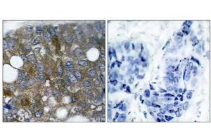 Immunohistochemical analysis of paraffin- embedded human breast carcinoma tissue using HSP27 (phospho-Ser15) antibody (E011164). (HSP27 anticorps  (pSer15))
