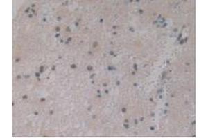IHC-P analysis of Human Glioma Tissue, with DAB staining. (IGFBPI anticorps  (AA 36-235))