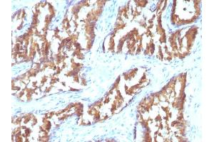 Formalin-fixed, paraffin-embedded human Prostate Carcinoma stained with IDH1 Mouse Monoclonal Antibody (IDH1/1152). (IDH1 anticorps  (AA 281-414))