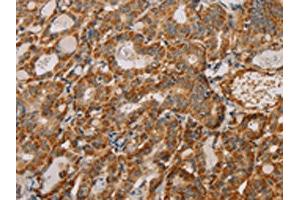 The image on the left is immunohistochemistry of paraffin-embedded Human thyroid cancer tissue using ABIN7130292(MTFR1 Antibody) at dilution 1/40, on the right is treated with fusion protein. (MTFR1 anticorps)